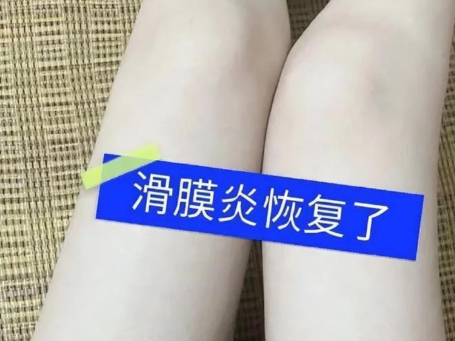 熊猫体育平台得了滑膜炎膝怎么办？试试这几款膏药！只需7天就能根治！(图3)