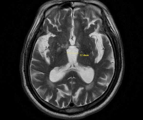 陕西省核工业二一五医院:83岁患者的大脑里医生抓住了一只闯祸的“蜂鸟”!(图2) 陕西省核工业二一五医院:83岁患者的大脑里医生抓住了一只闯祸的“蜂鸟”!(图2)