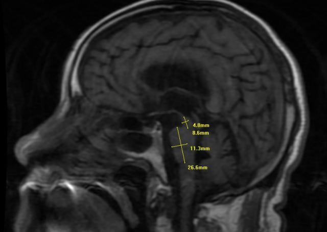 陕西省核工业二一五医院:83岁患者的大脑里医生抓住了一只闯祸的“蜂鸟”!(图3) 陕西省核工业二一五医院:83岁患者的大脑里医生抓住了一只闯祸的“蜂鸟”!(图3)