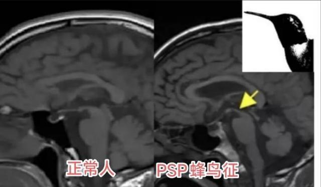 陕西省核工业二一五医院:83岁患者的大脑里医生抓住了一只闯祸的“蜂鸟”!(图4) 陕西省核工业二一五医院:83岁患者的大脑里医生抓住了一只闯祸的“蜂鸟”!(图4)